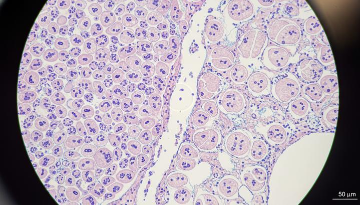 Микроскопическое изображение ткани печени с участками здоровых клеток и клеток, пораженных жировой дистрофией.