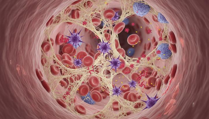 Микроскопическое изображение микротромбов в капилляре. Эритроциты, запутавшиеся в сети белка фибрина на фоне воспаления.
