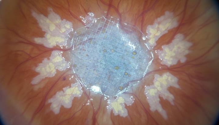 Имплант из стволовых клеток может вернуть зрение при дегенерации сетчатки Биоинженерный имплант в виде тонкой пленки со стволовыми клетками, расположенный на поверхности сетчатки человеческого глаза.