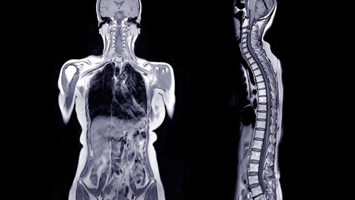 Ученые: Первая подтвержденная смерть от клещевой аллергии на красное мясо