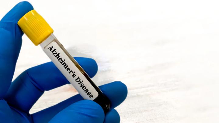 Функция почек влияет на показатели биомаркеров Альцгеймера без увеличения риска деменции